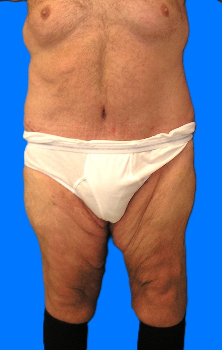 After Image: Patient Case #1299 - front