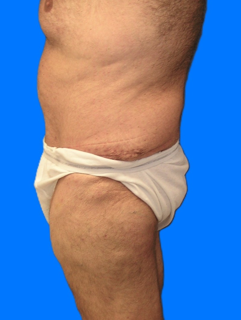 After Image: Patient Case #1299 - left-side