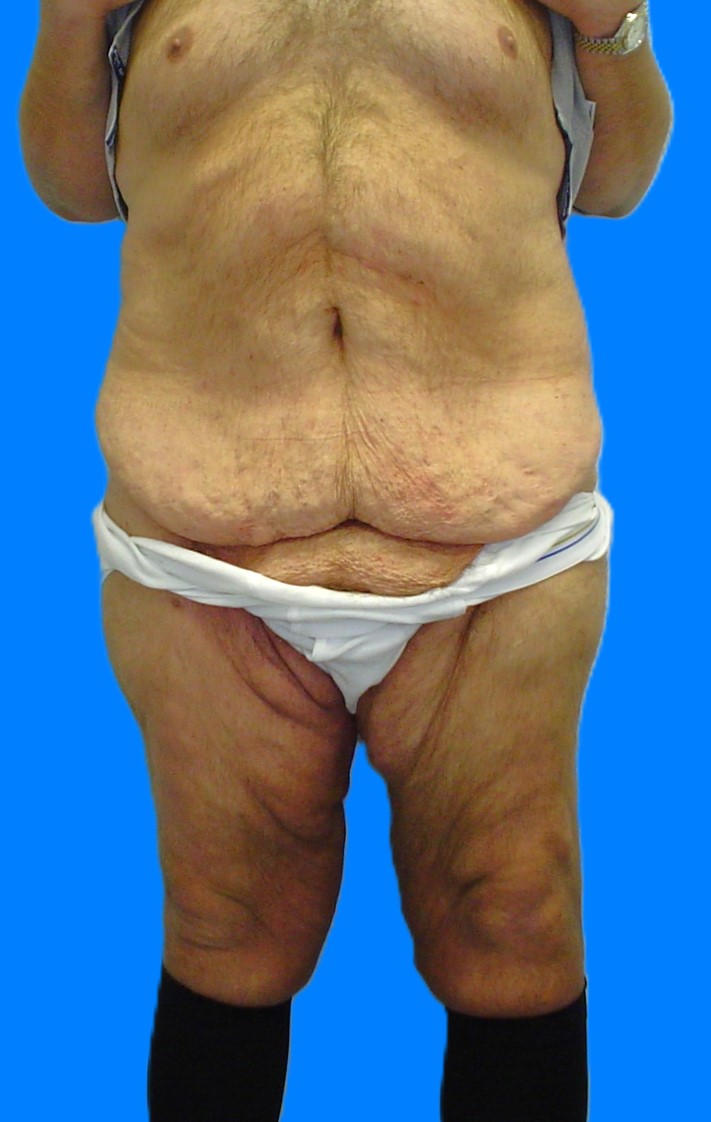 Before Image: Patient Case #1299 - front