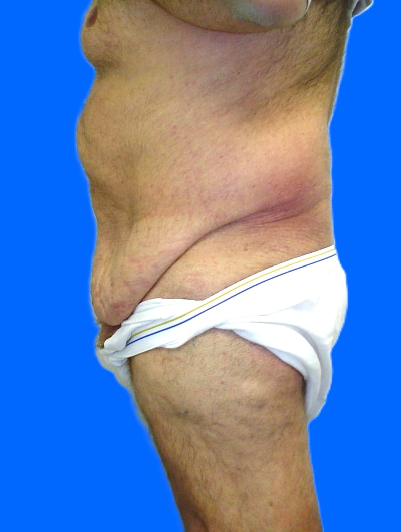 Before Image: Patient Case #1299 - left-side