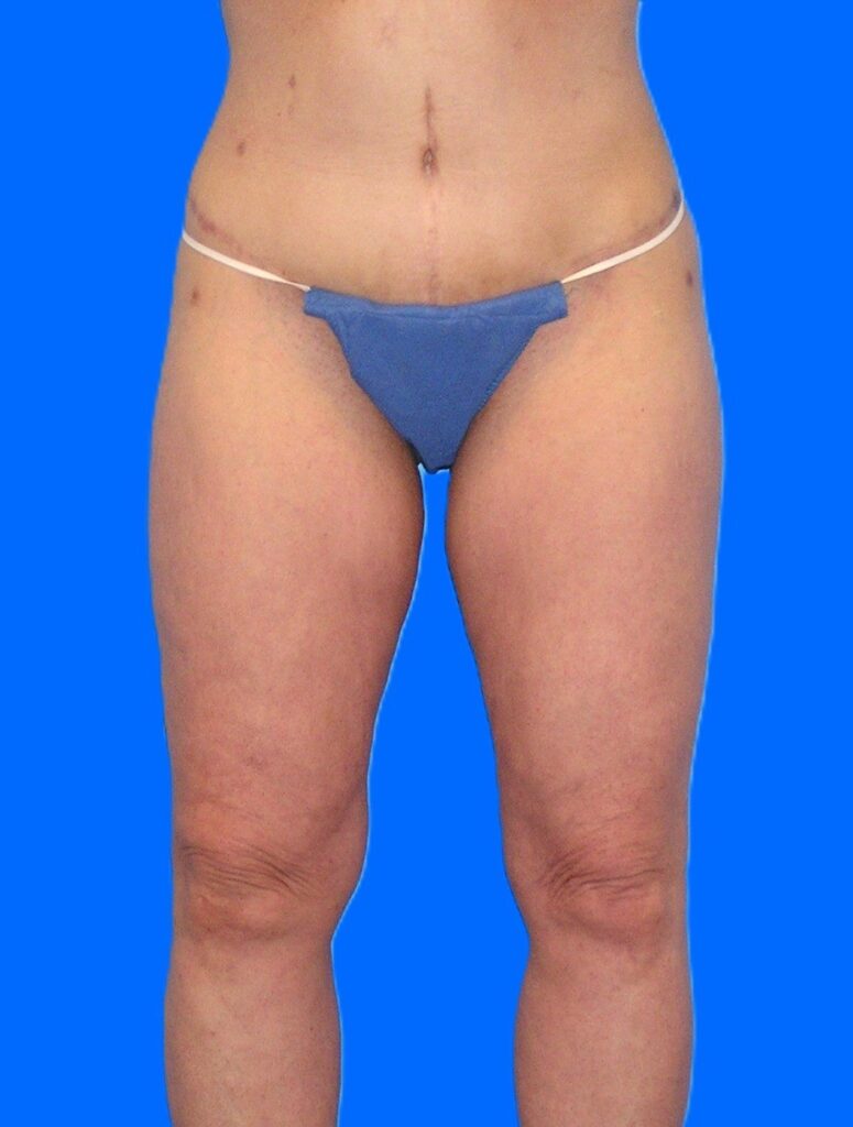 After Image: Patient Case #1302 - front