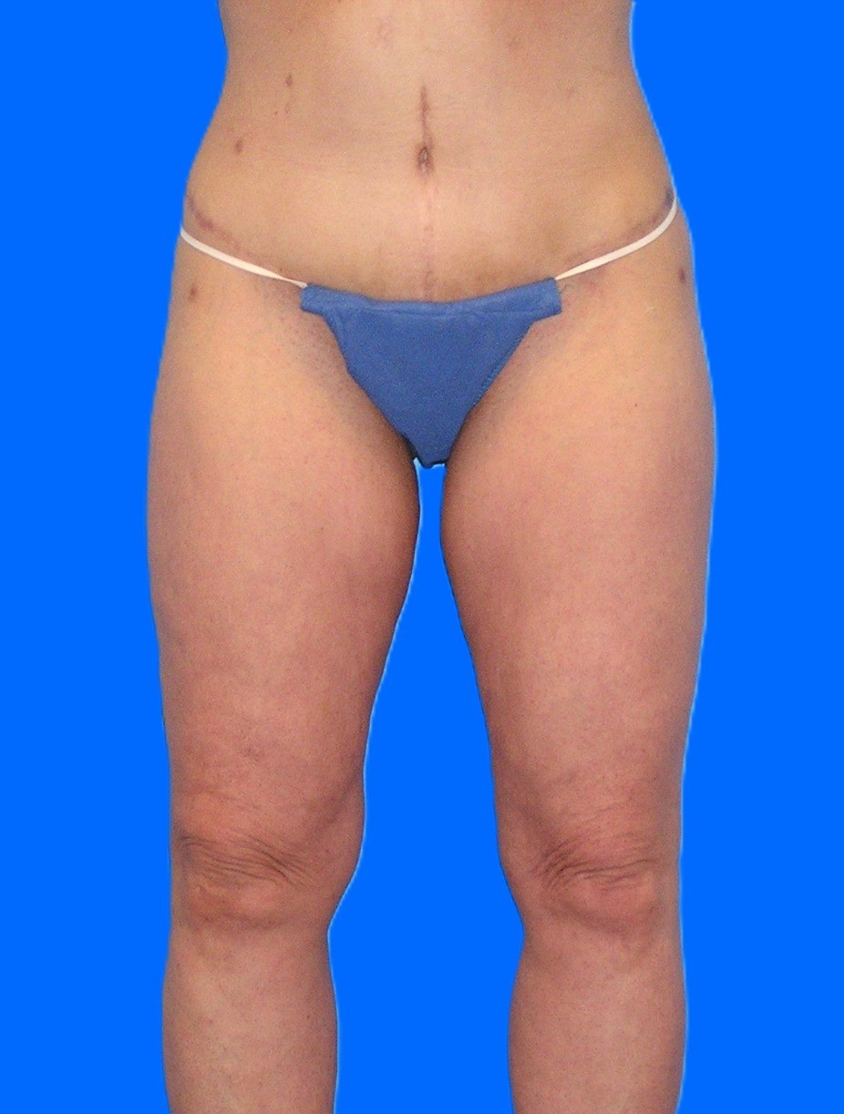 After Image: Patient Case #1302 - front