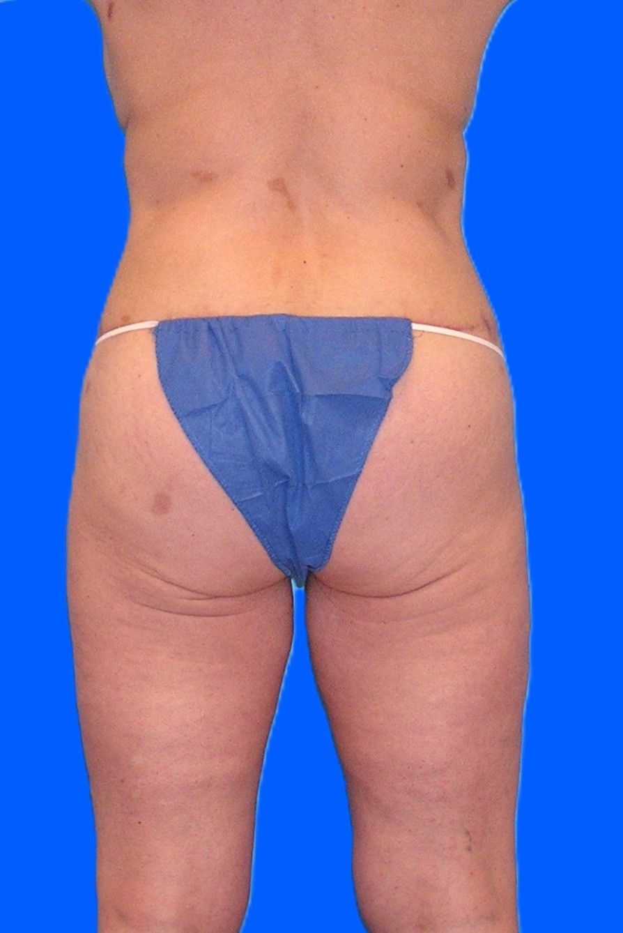 After Image: Patient Case #1302 - back