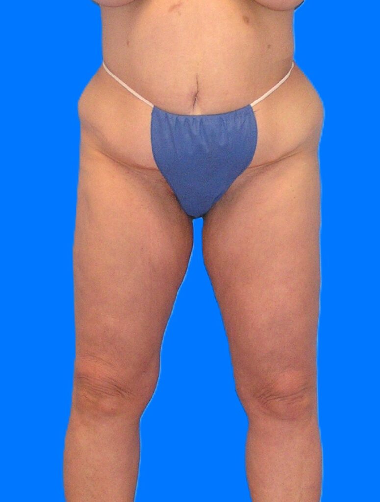 Before Image: Patient Case #1302 - front