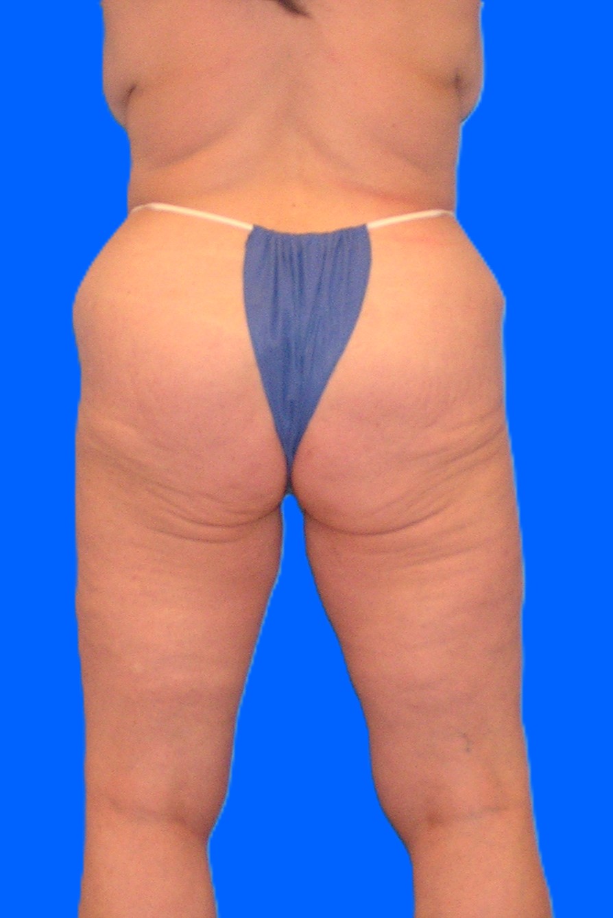 Before Image: Patient Case #1302 - back