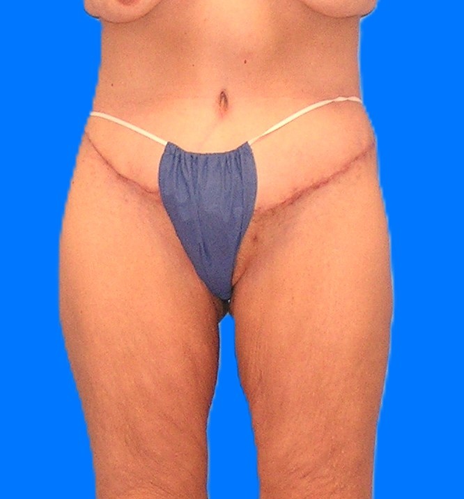 After Image: Patient Case #1304 - front