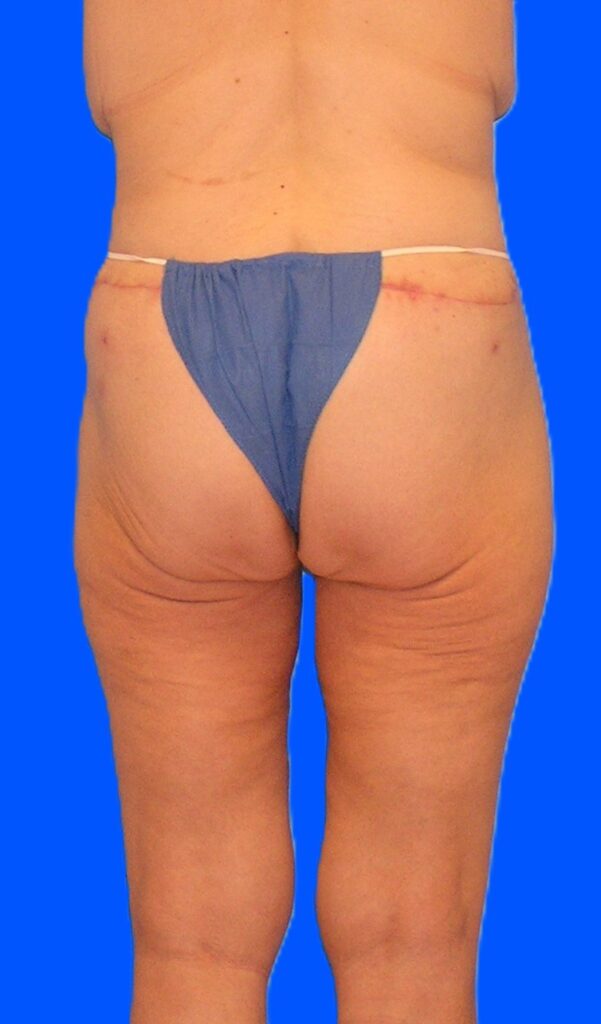 After Image: Patient Case #1304 - back