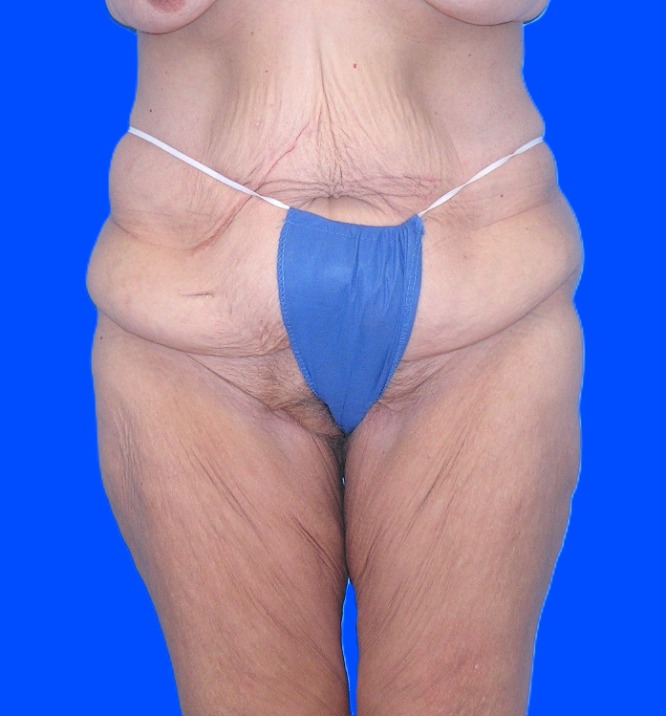 Before Image: Patient Case #1304 - front