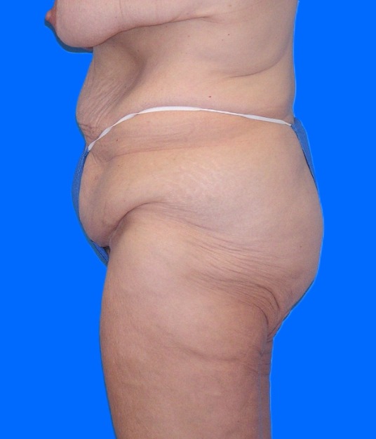 Before Image: Patient Case #1304 - left-side