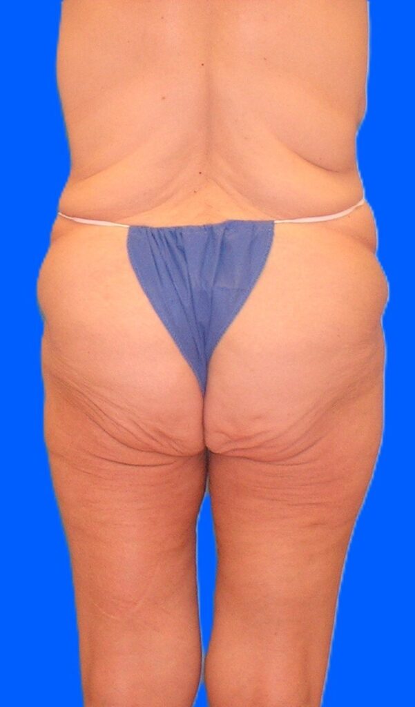 Before Image: Patient Case #1304 - back