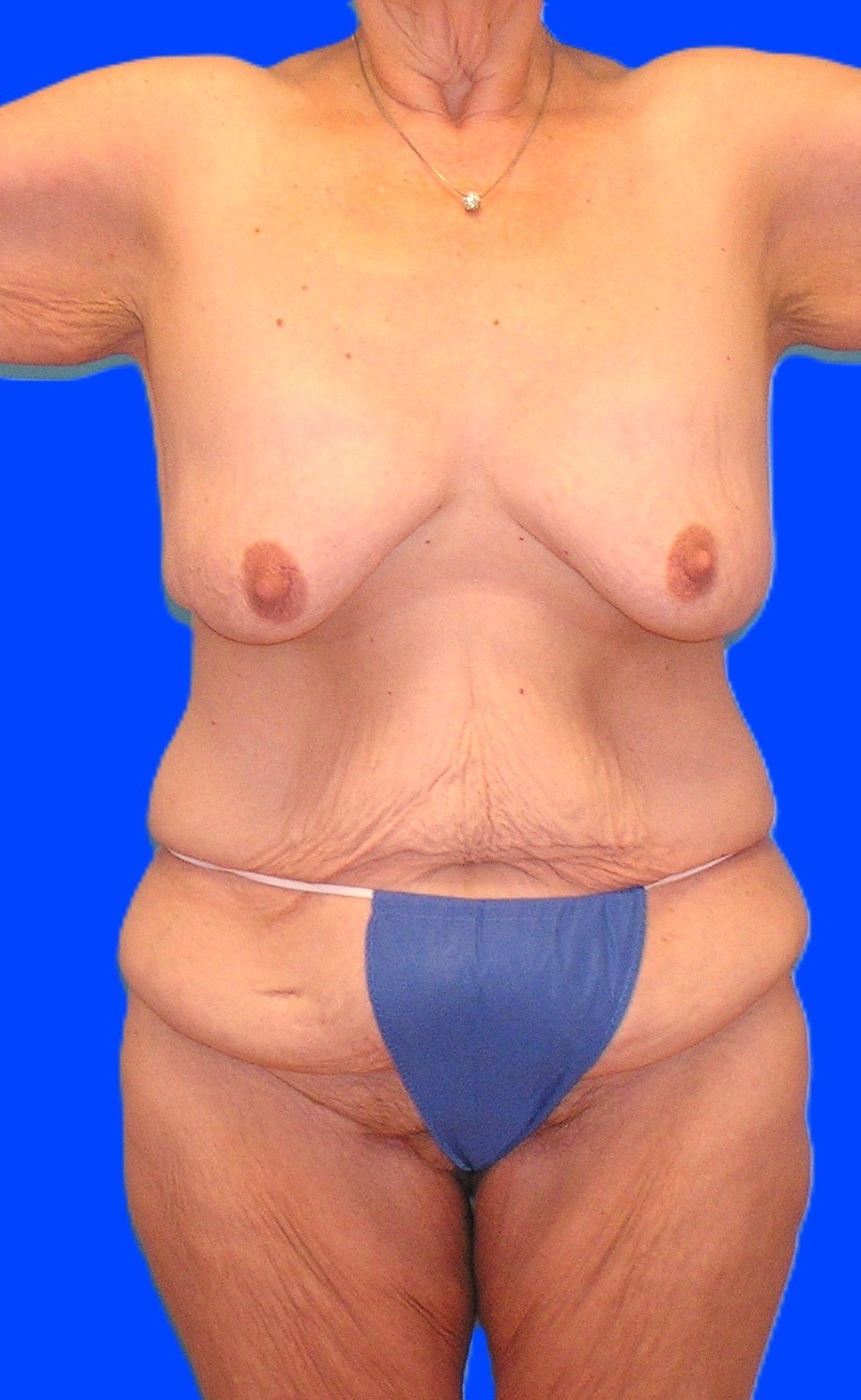 Before Image: Patient Case #1304 - front
