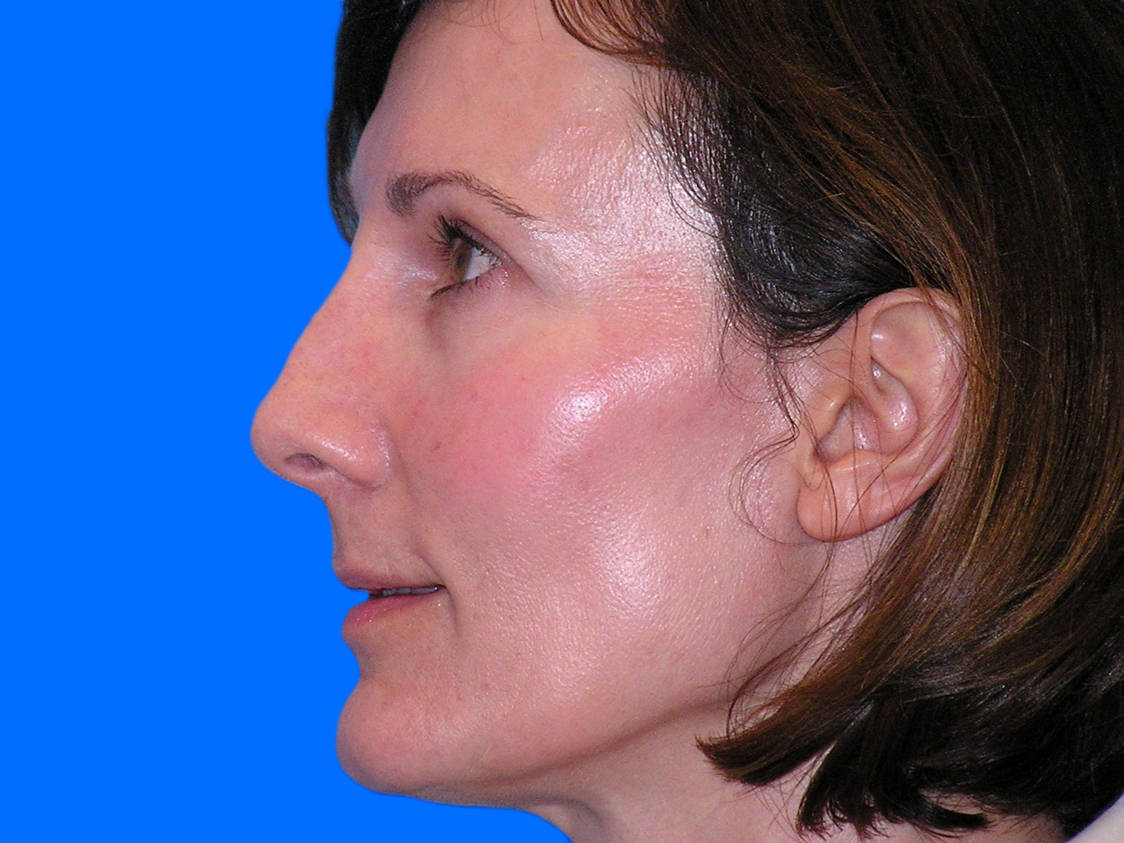 After Image: Patient Case #1345 - left-side