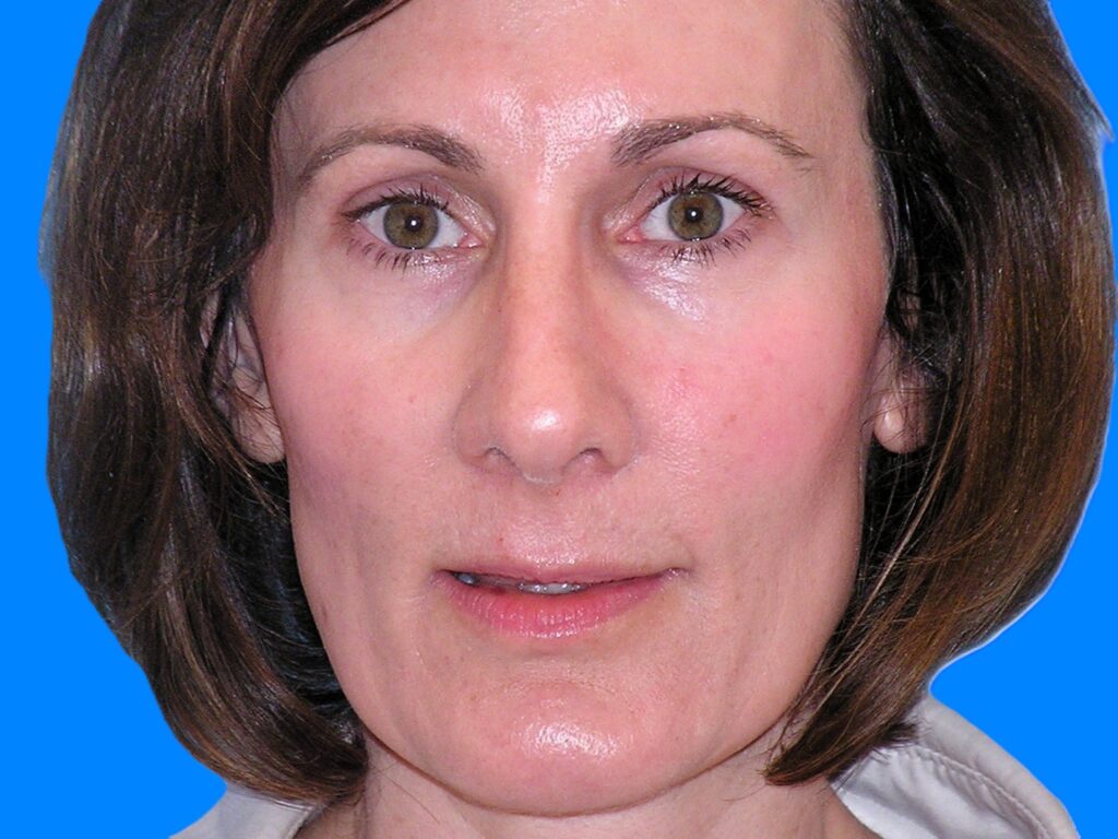 After Image: Patient Case #1345 - front
