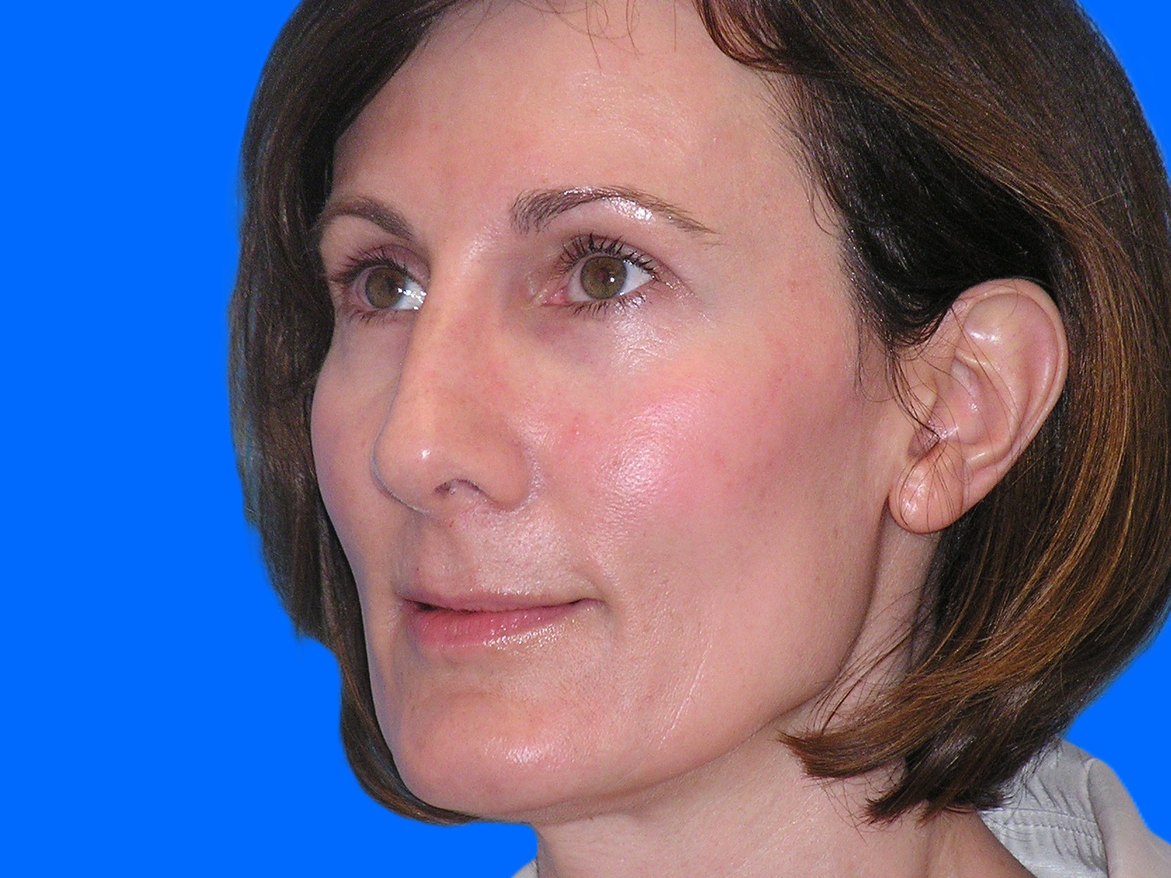 After Image: Patient Case #1345 - left-front-oblique