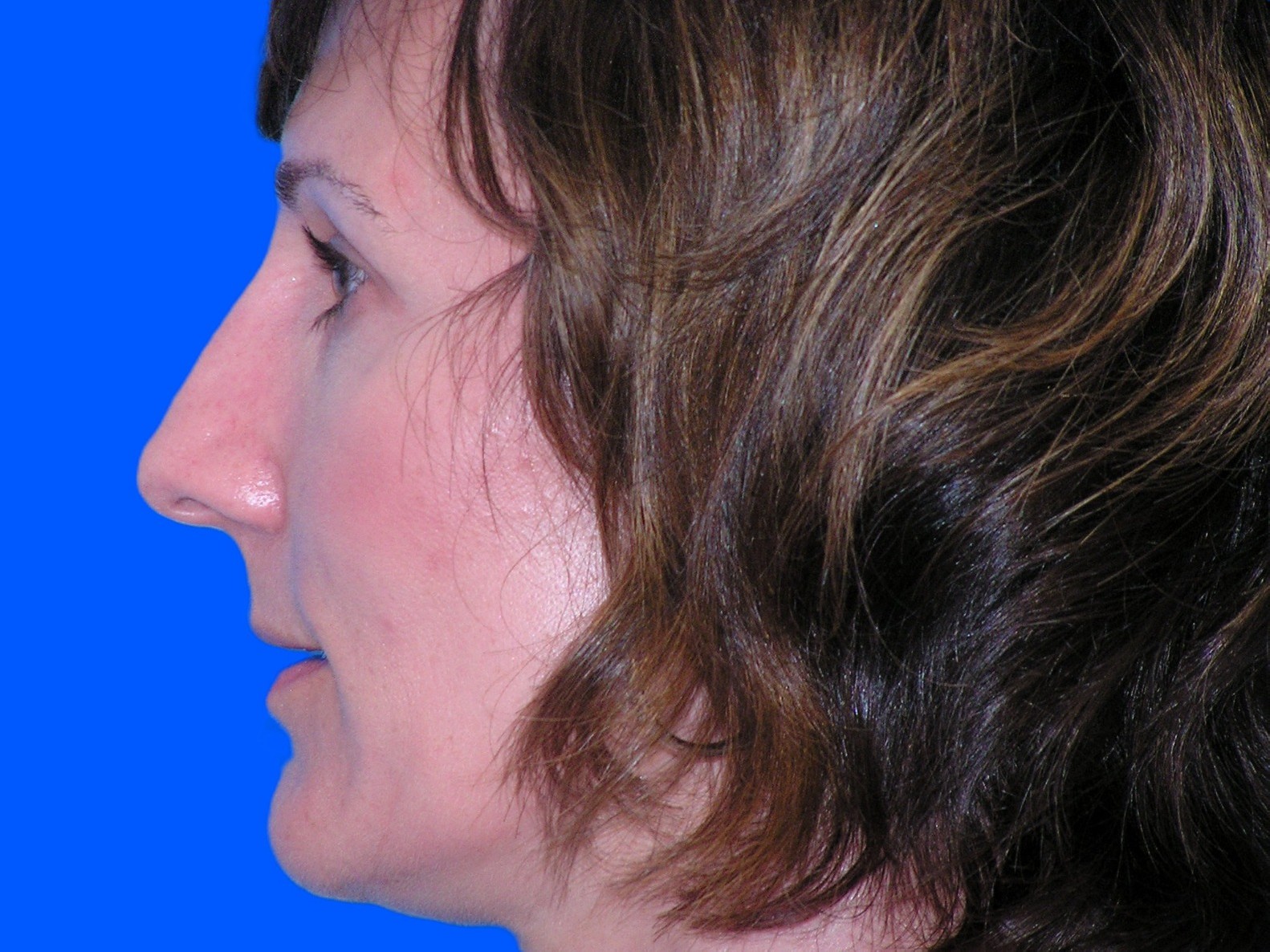 Before Image: Patient Case #1345 - left-side