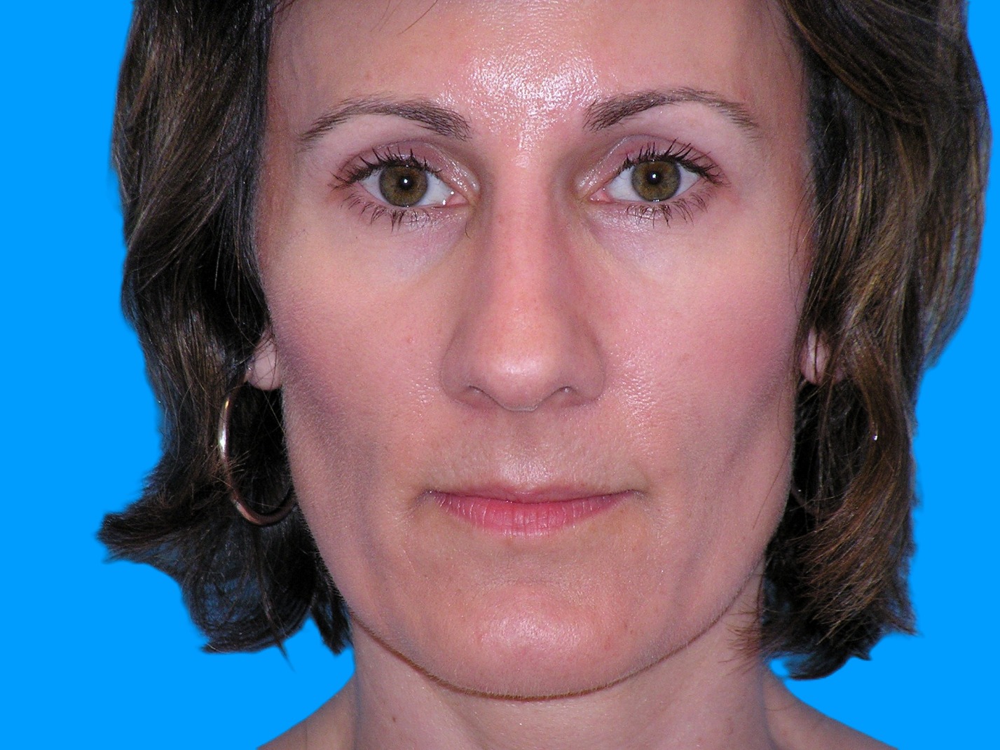 Before Image: Patient Case #1345 - front