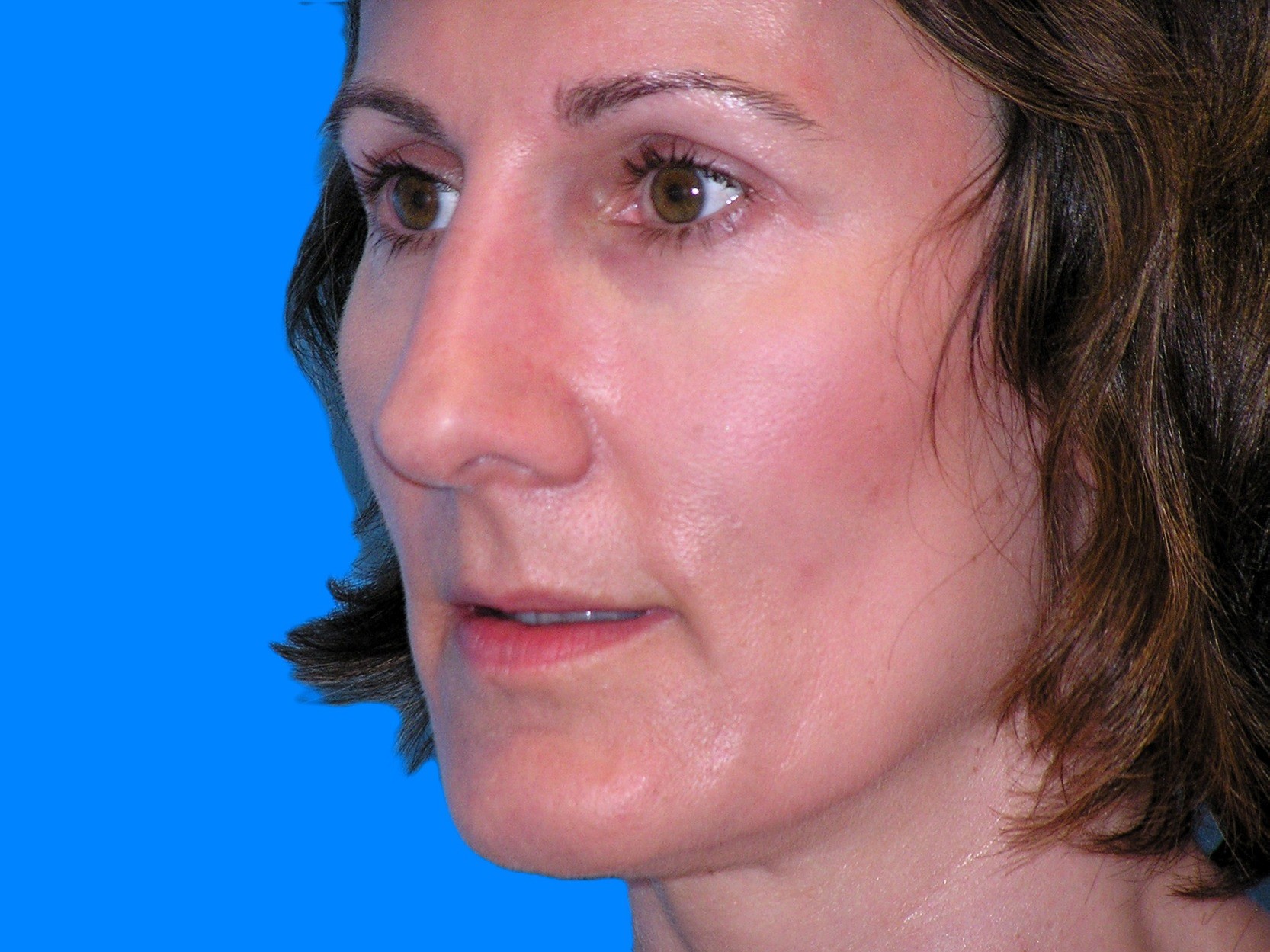 Before Image: Patient Case #1345 - left-front-oblique