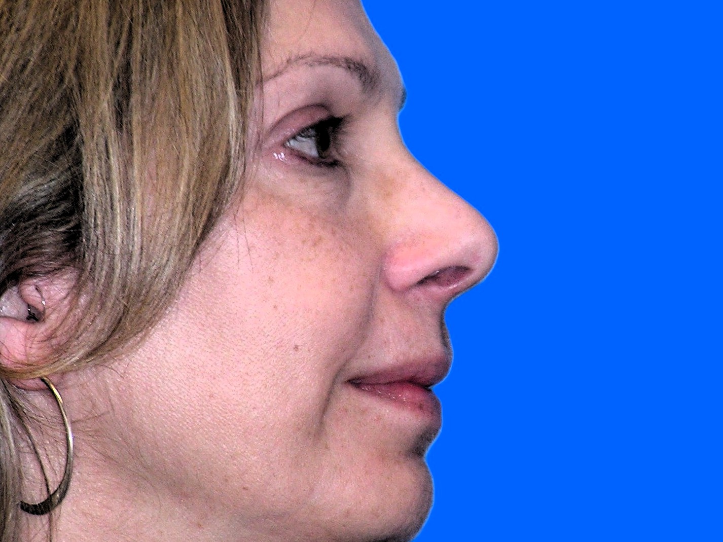 After Image: Patient Case #1348 - right-side