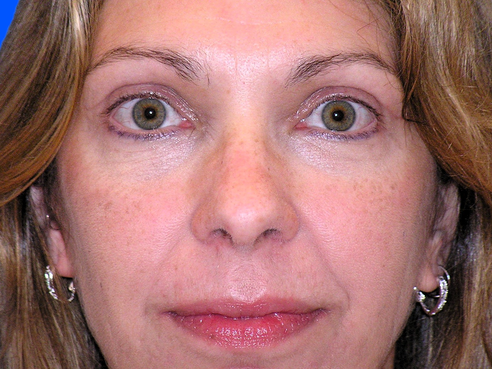 After Image: Patient Case #1348 - front