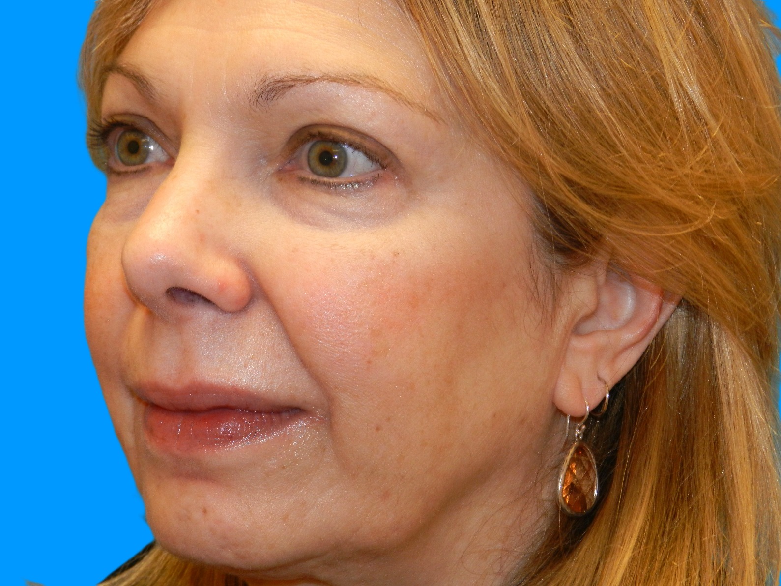 After Image: Patient Case #1348 - left-front-oblique