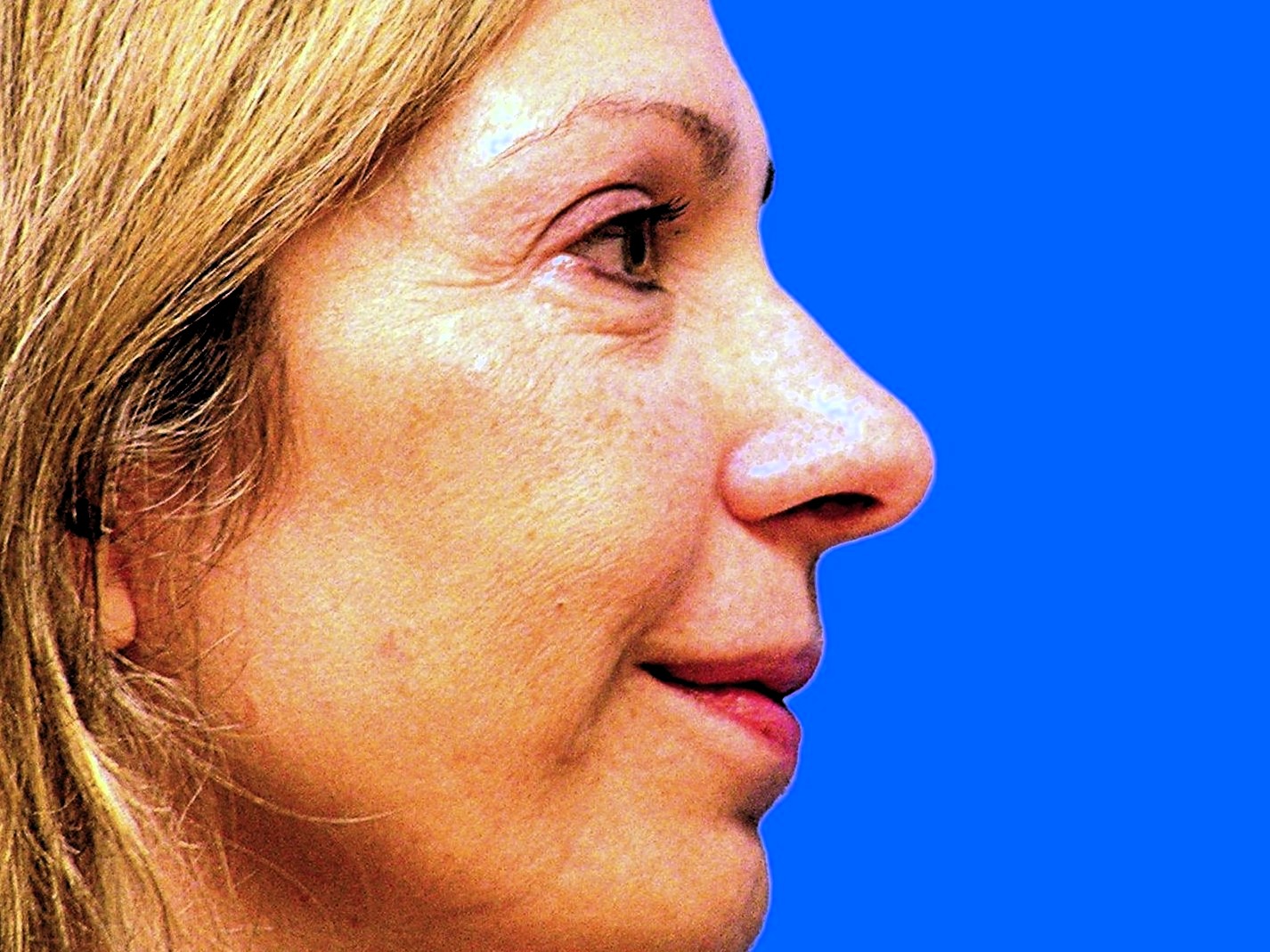 Before Image: Patient Case #1348 - right-side