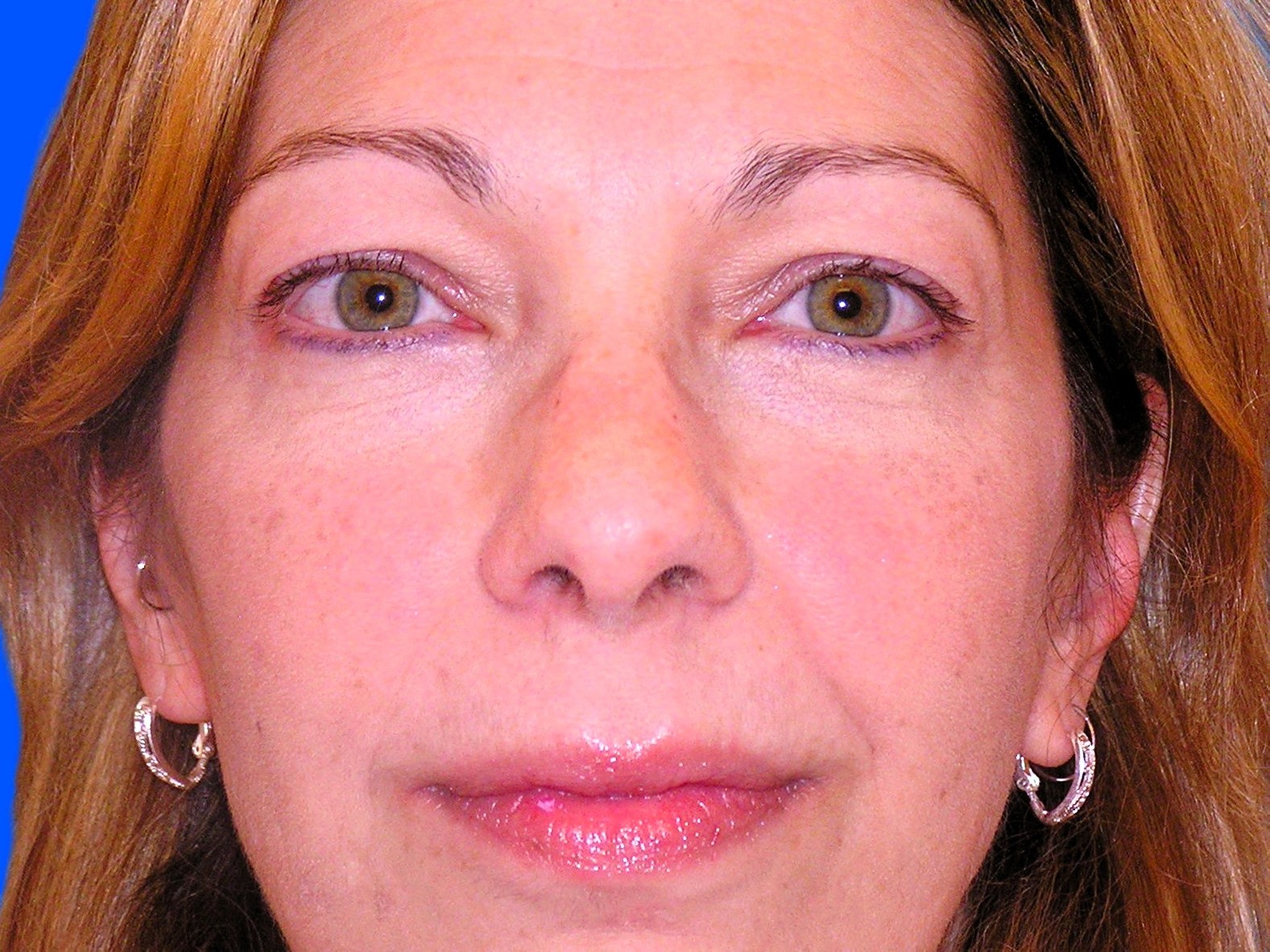 Before Image: Patient Case #1348 - front