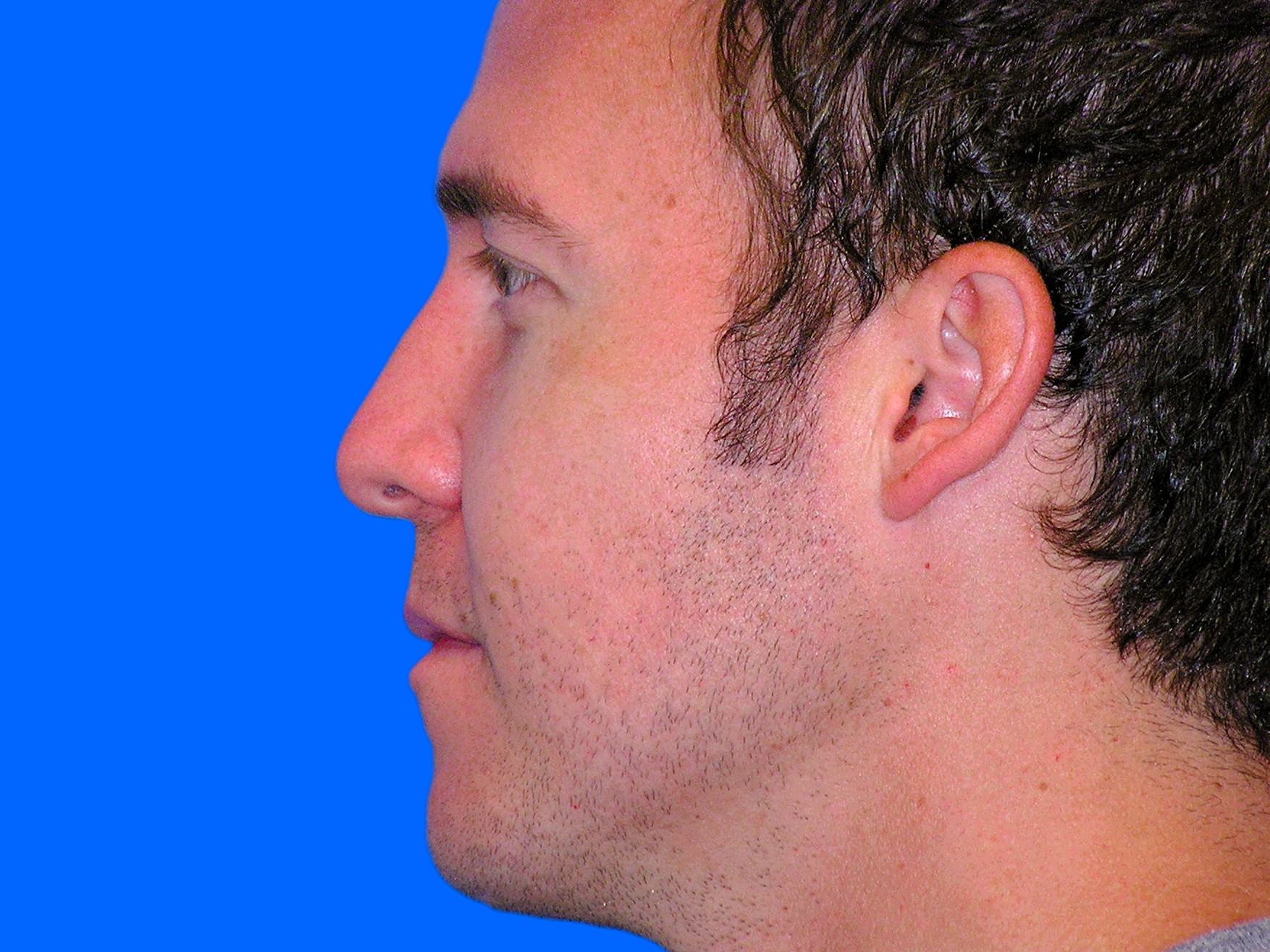 After Image: Patient Case #1349 - left-side