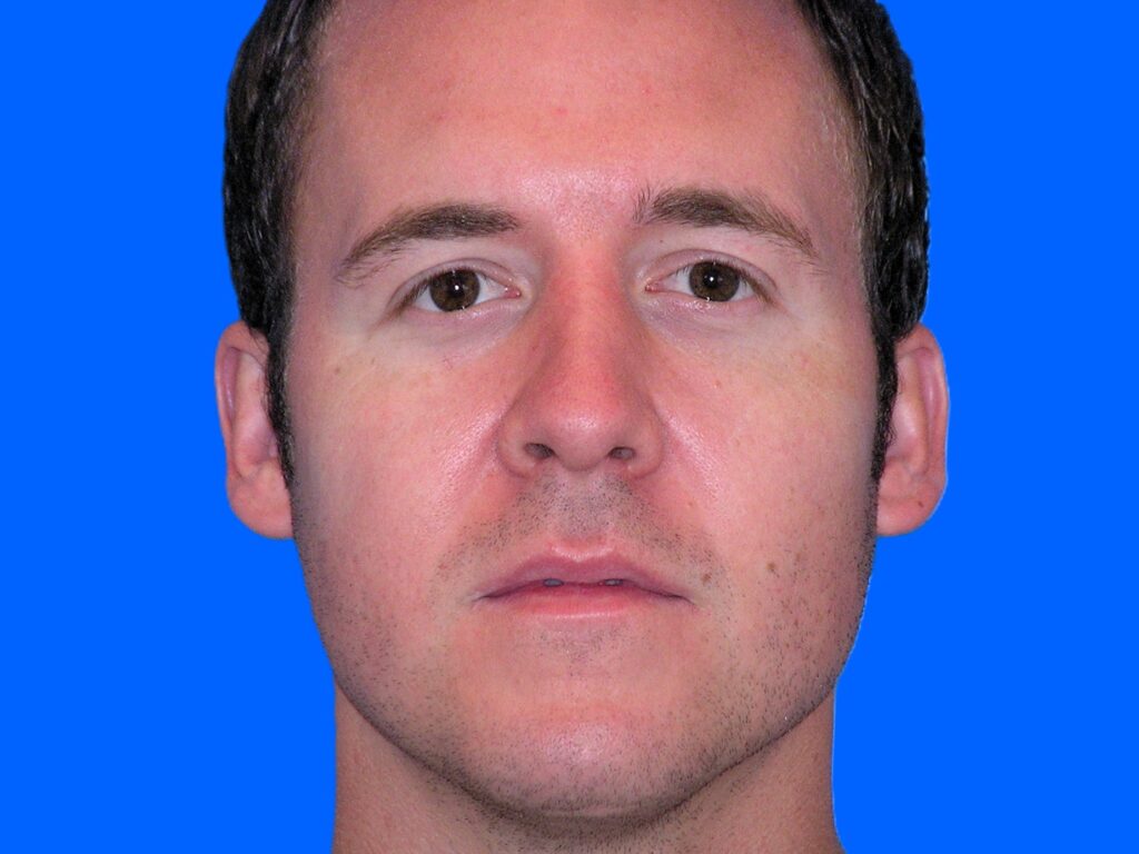 After Image: Patient Case #1349 - front