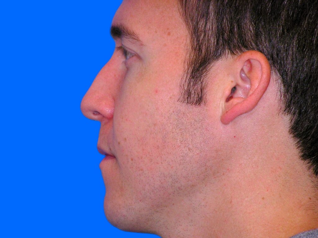 Before Image: Patient Case #1349 - left-side