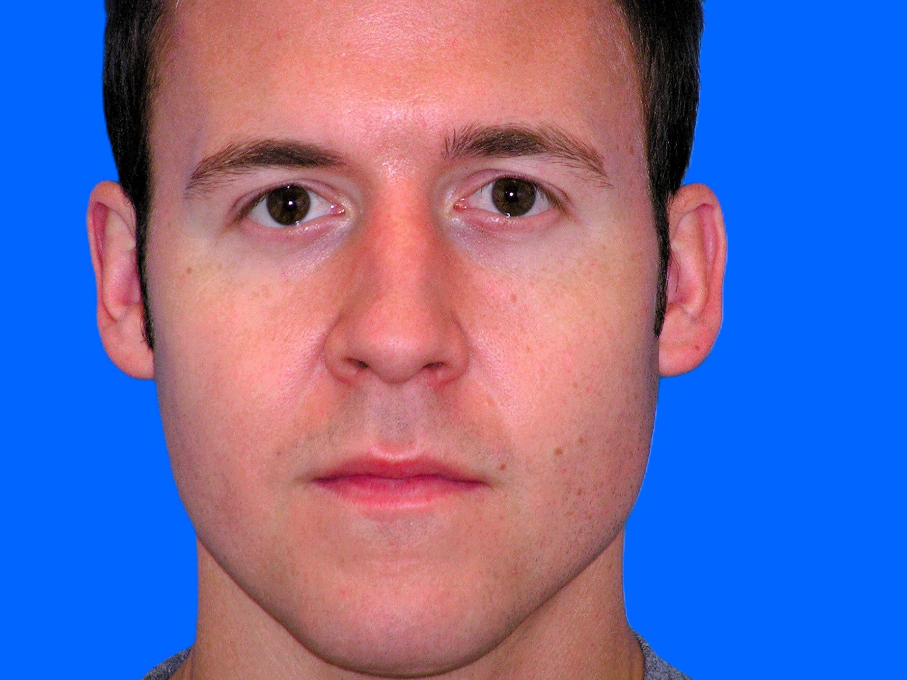 Before Image: Patient Case #1349 - front