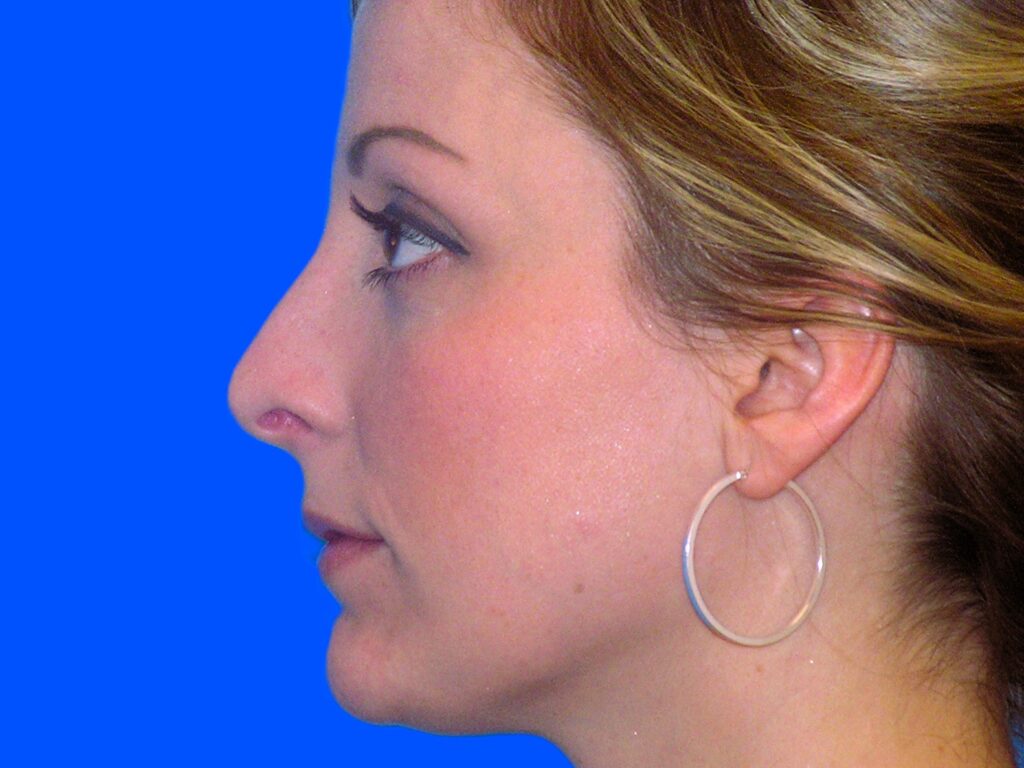After Image: Patient Case #1351 - left-side
