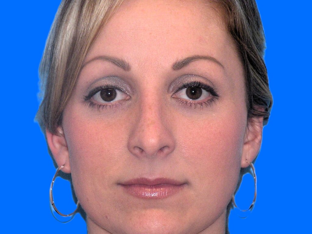 After Image: Patient Case #1351 - front