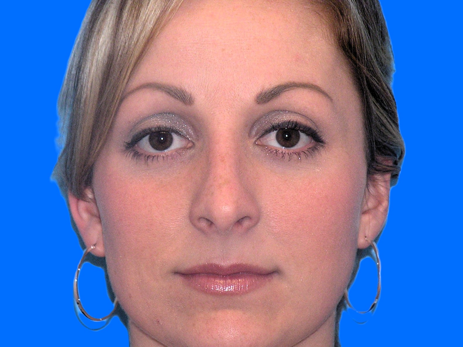 After Image: Patient Case #1351 - front