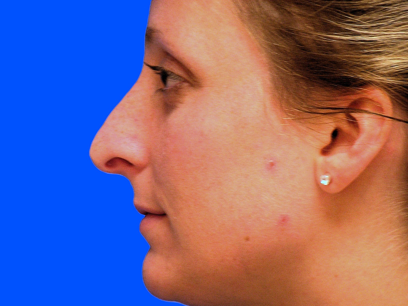 Before Image: Patient Case #1351 - left-side
