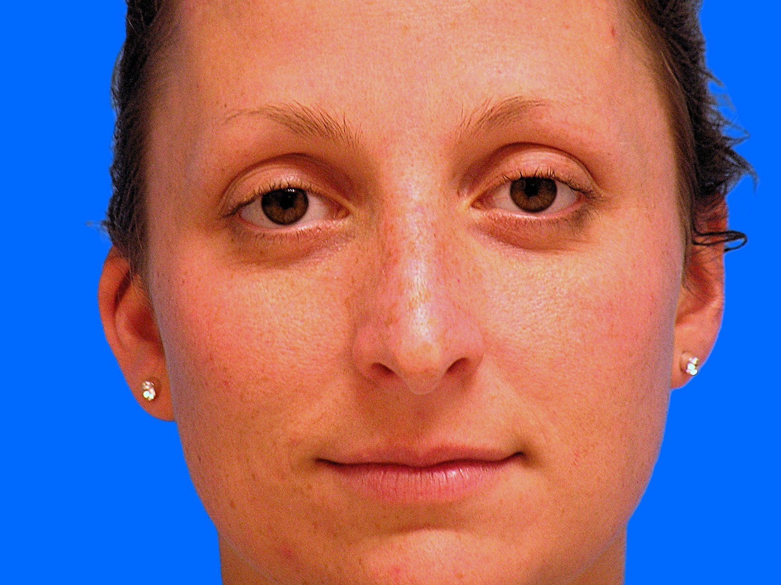 Before Image: Patient Case #1351 - front