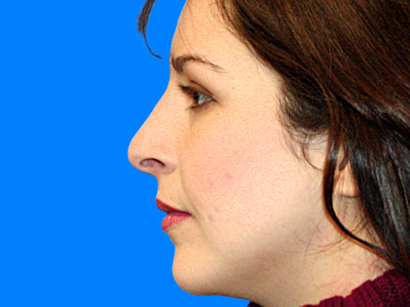 After Image: Patient Case #1396 - left-side