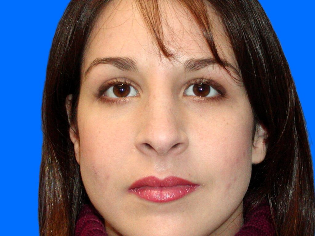 After Image: Patient Case #1396 - front