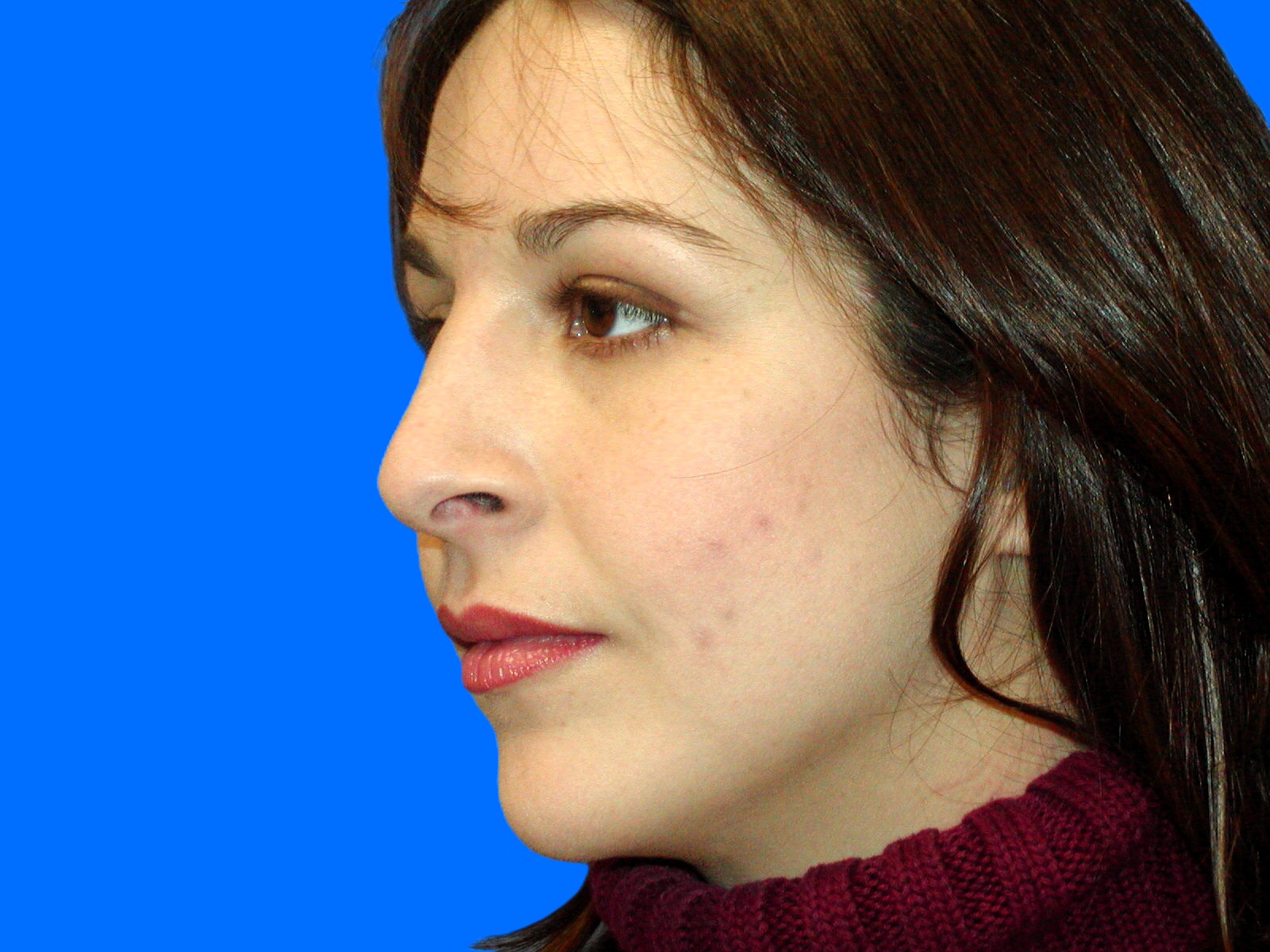 After Image: Patient Case #1396 - left-front-oblique