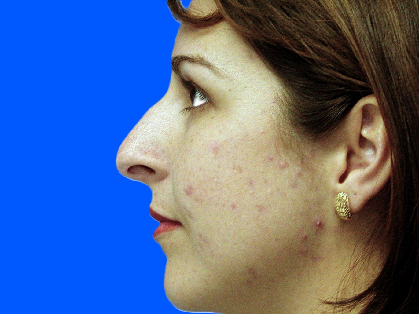 Before Image: Patient Case #1396 - left-side