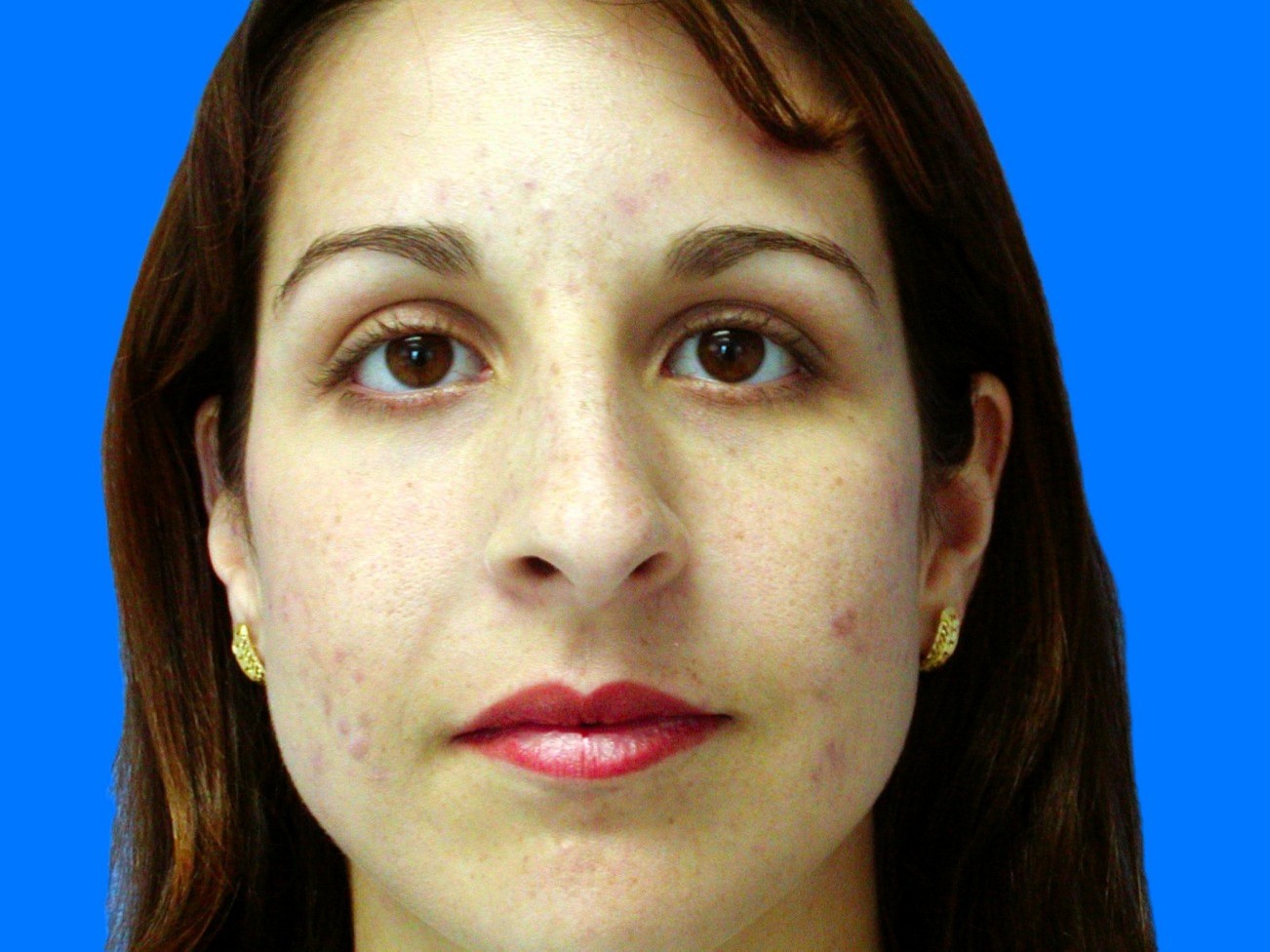 Before Image: Patient Case #1396 - front