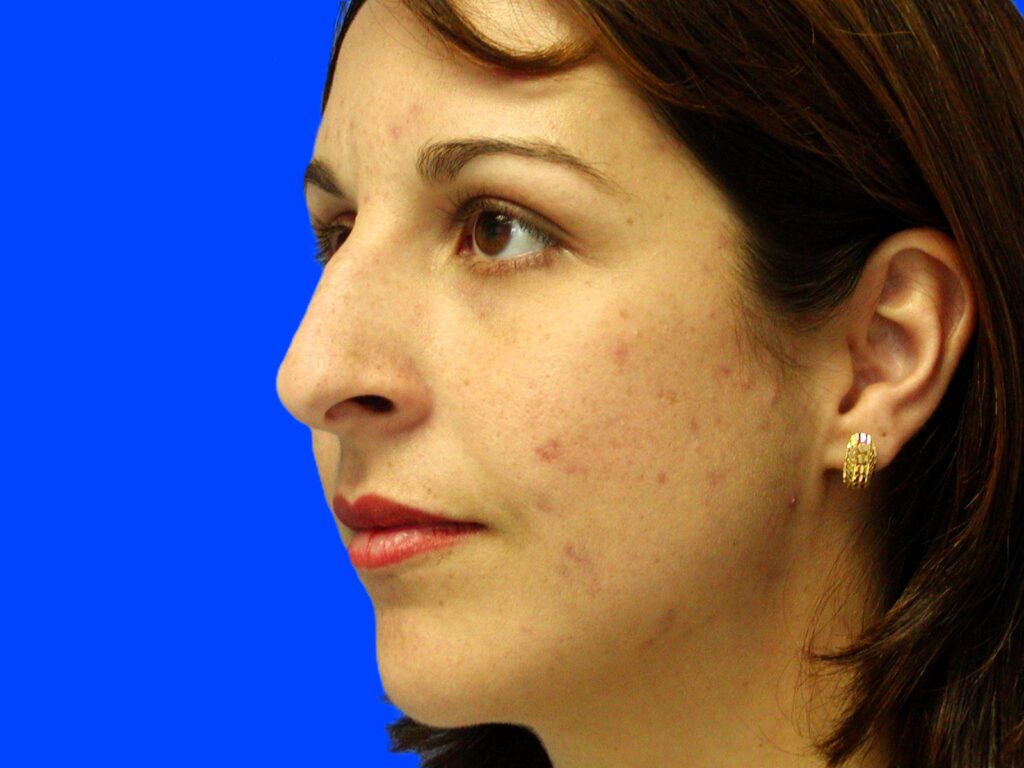 Before Image: Patient Case #1396 - left-front-oblique