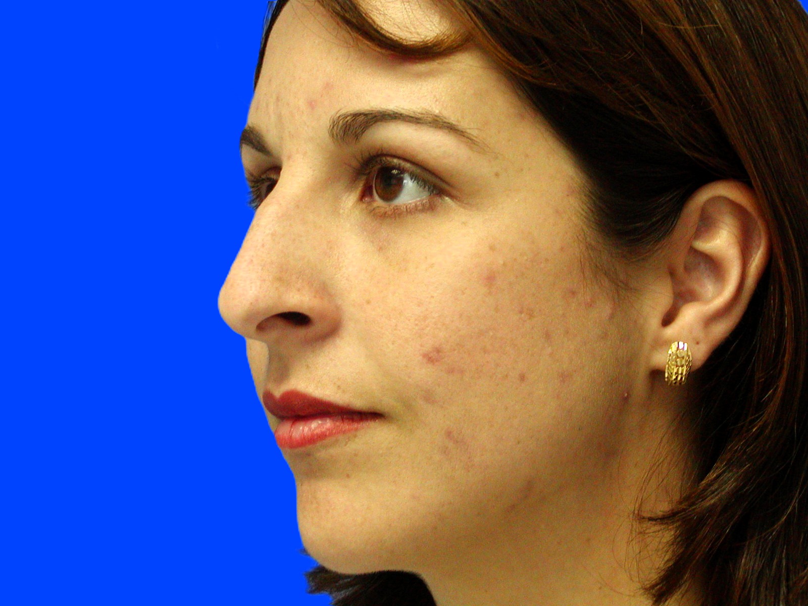 Before Image: Patient Case #1396 - left-front-oblique