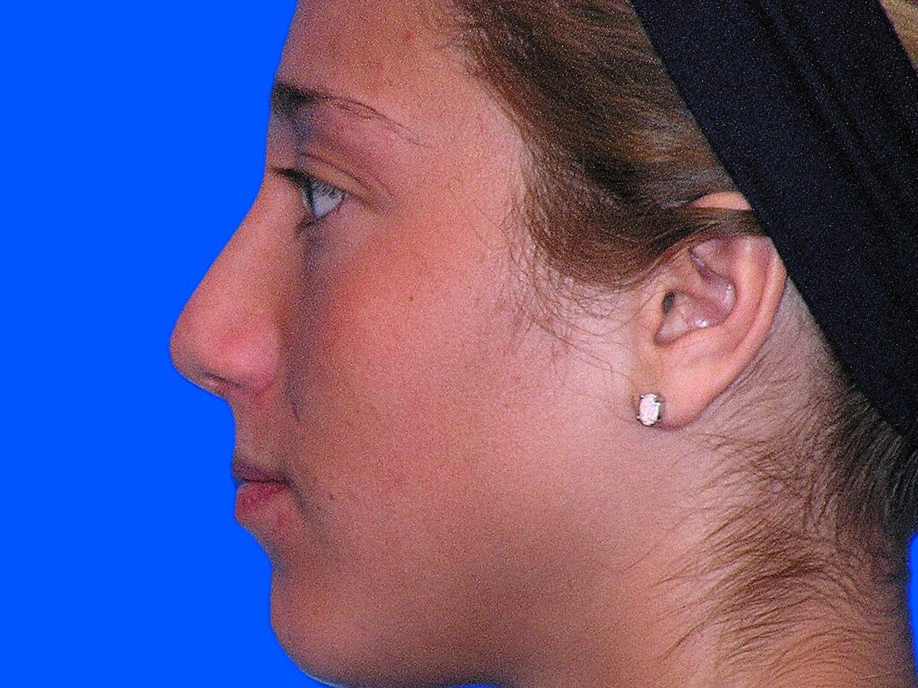 After Image: Patient Case #1402 - left-side