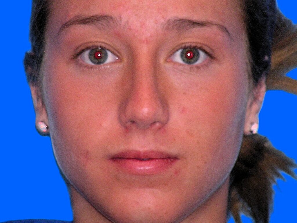 After Image: Patient Case #1402 - front