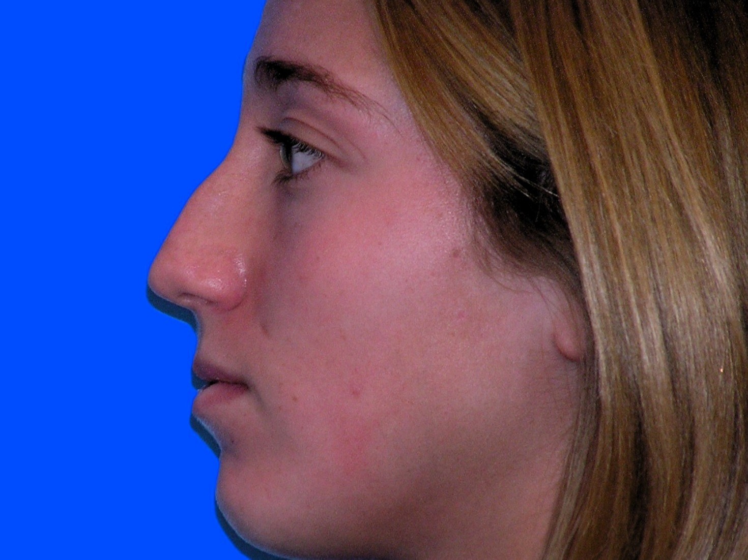 Before Image: Patient Case #1402 - left-side