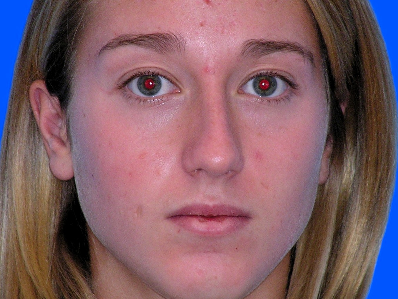 Before Image: Patient Case #1402 - front