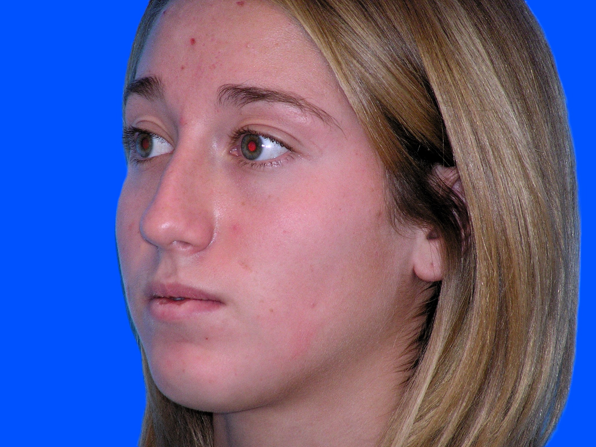 Before Image: Patient Case #1402 - left-front-oblique