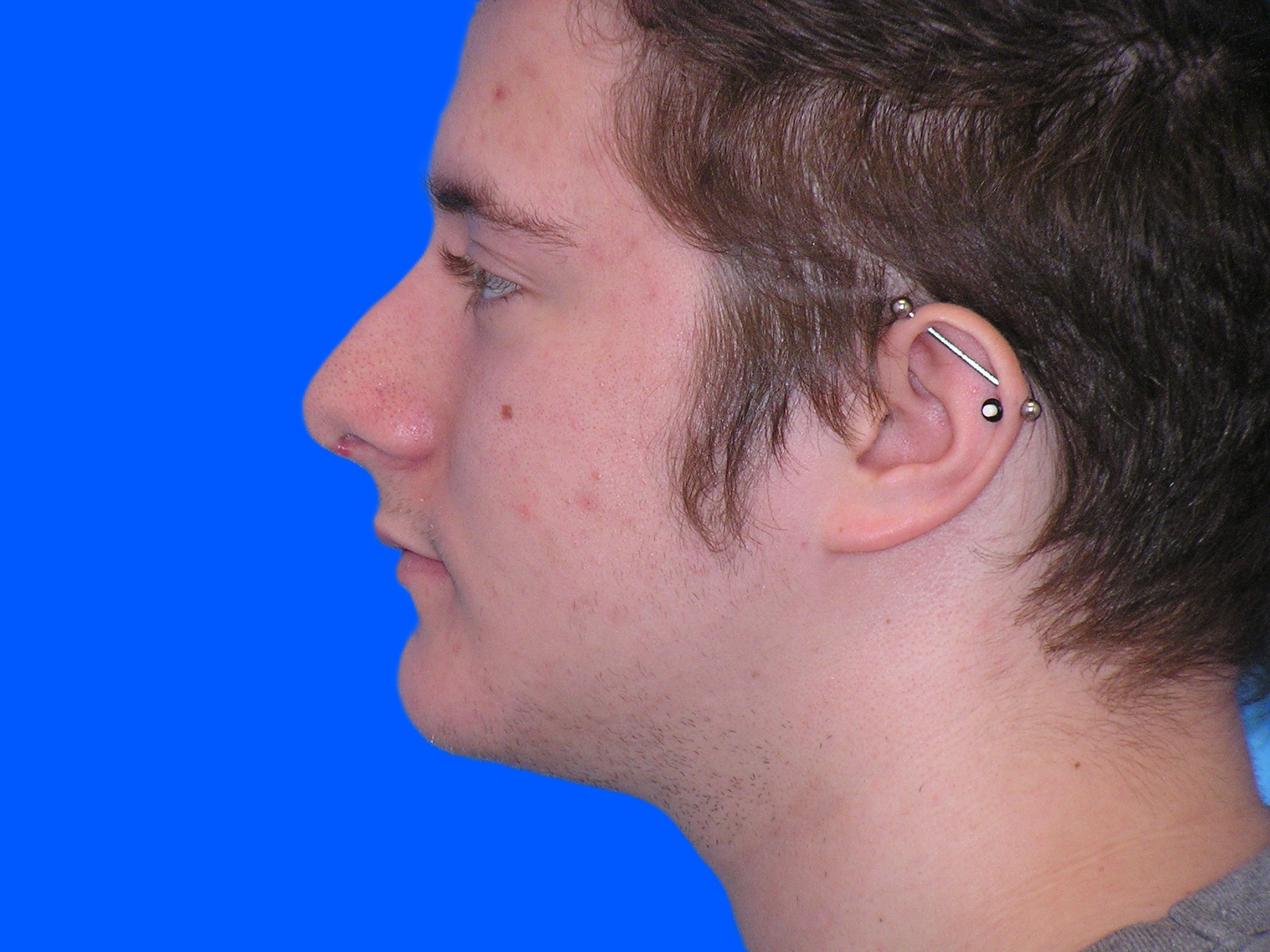 After Image: Patient Case #1404 - left-side