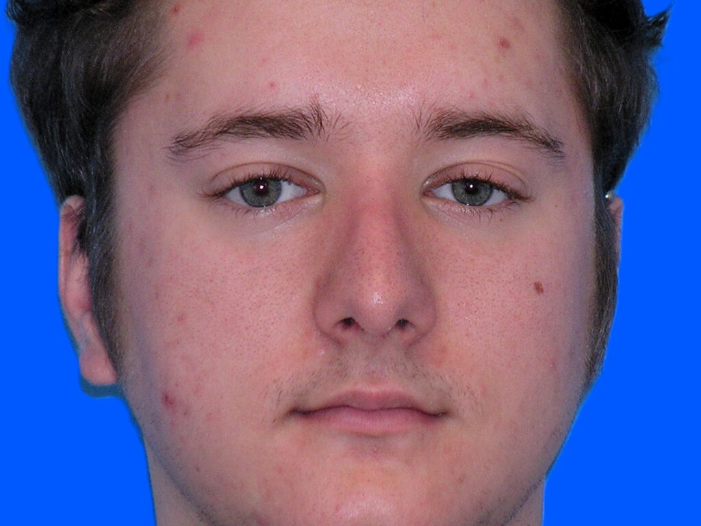 After Image: Patient Case #1404 - front