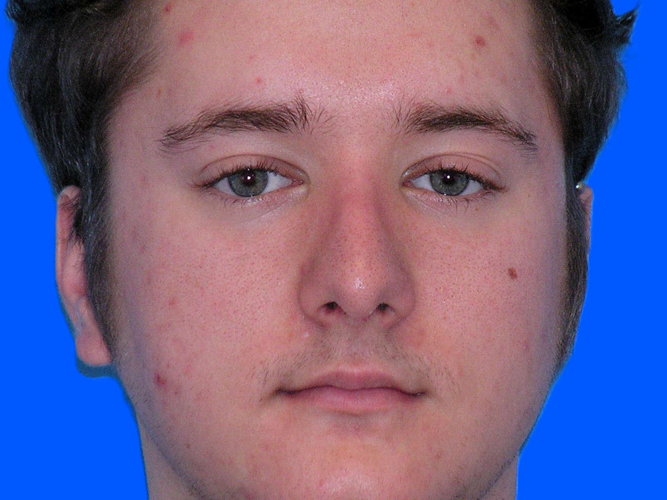 After Image: Patient Case #1404 - front